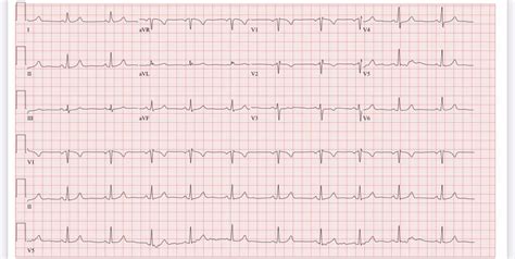 NAD but the echo is probably out of an abundance of caution and because the. . Possible left atrial enlargement borderline ecg reddit